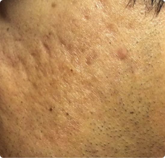 Before: Acne scarring on a cheek, before and after one RF microneedling session