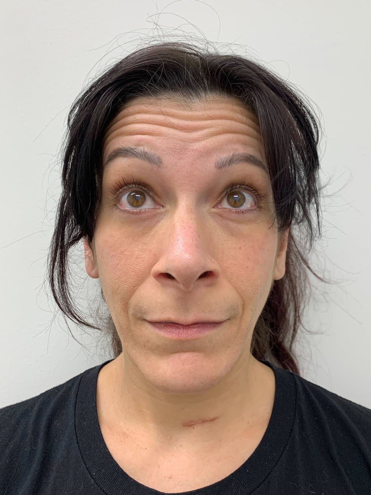 Before: Forehead lines on a woman raising her brows, before and after Botox