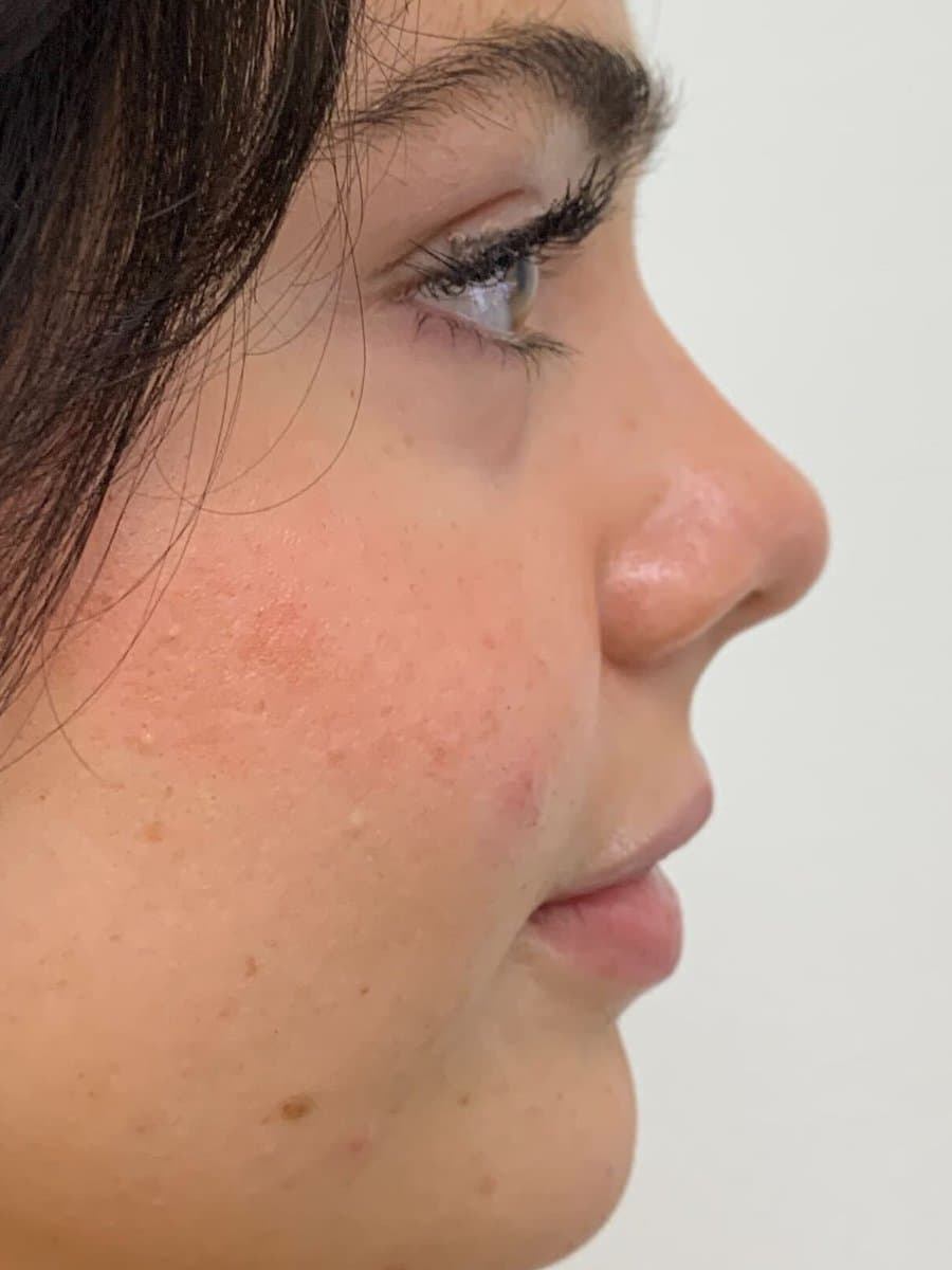 Before: Profile view of a woman's face before and after cheek, nose, chin, and lip filler placed in one visit, showing a more balanced profile