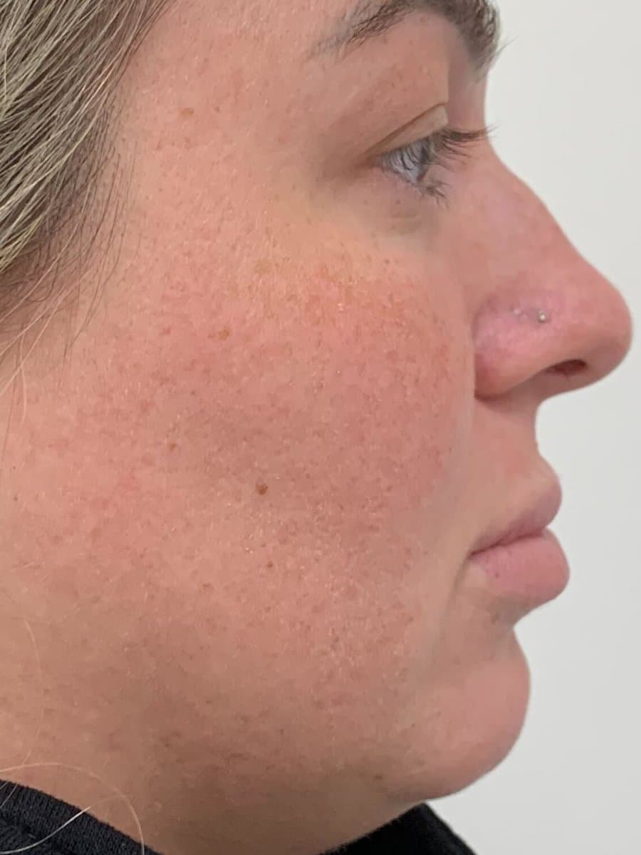 Before: Profile view of a woman's nose before and after nose filler, with the dorsal bump smoothed into a straighter line