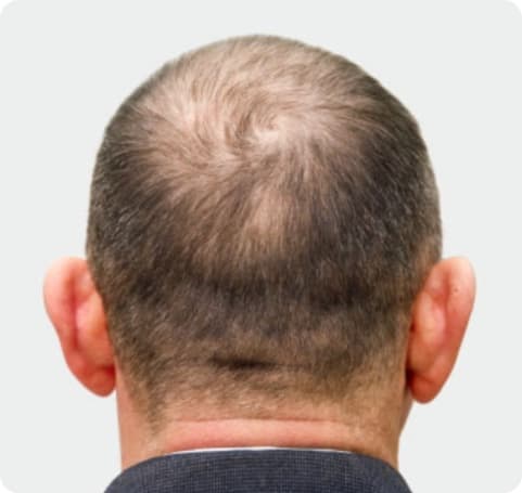 Before: Crown thinning on a man, before and after PRP hair restoration
