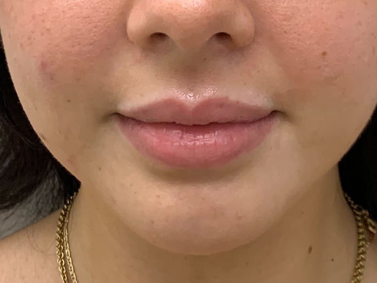 Before: Front view of a woman's lips before and after lip filler, showing added fullness and definition